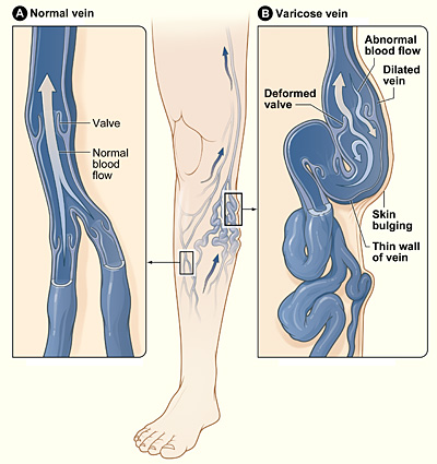 Diagram comparing normal and varicose veins in the leg